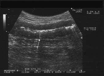 BS. Crohn's ileitis: the thickened wall (arrow) of the ileum with narrowed lumen is evident.