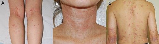A, Eczematiform lesions of the lower extremities induced by infliximab. B, Eczematiform lesions of the face and neck induced by infliximab. C, Psoriasiform lesions of the trunk and extensor surface induced by infliximab.