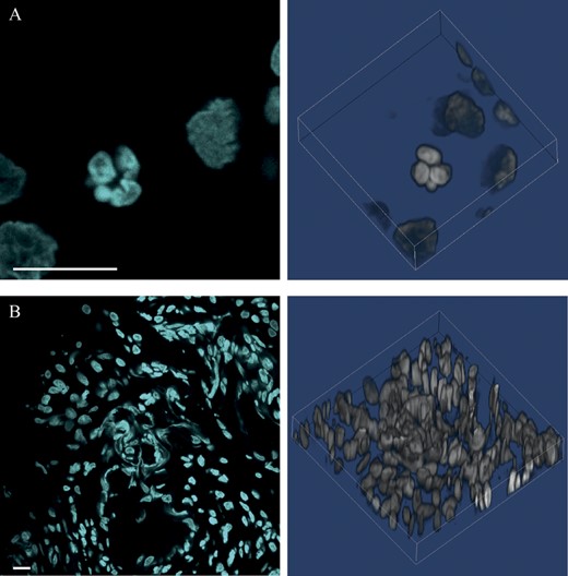 Confocal microscopy images of TO-PRO-3–stained biopsy slices from the UC group (scale bars 100 μm): (A) UC_6 with an intact neutrophil, with segmented multiobulated-shaped nucleus; (B) UC_4 with NET formation by excretion of the neutrophil DNA.