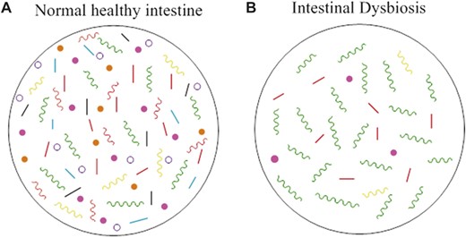Normal and dysbiotic intestinal microbiota. A, The healthy intestines of normal individuals are colonized by a wide range of bacteria of more than 1000 species. In healthy individuals, these bacteria are in a homeostatic balance between commensal and potentially pathogenic bacteria, and the intestinal tract does not display overgrowth of pathogenic bacteria. The microflora provide the host with protection from foreign microbes, acting as a central line of resistance to colonization by these exogenous bacteria. This protection is known as the “barrier effect,” or colonization resistance.1 Through the mucosal surface of the intestine, the microbiota interacts with the host immune system, providing the host with immune regulatory functions, like priming the mucosal immune system.1,3 The microbiota also possesses various metabolic functions, like breaking down complex carbohydrates and generating short-chain fatty acids, from which the host benefits.1,4 Surprisingly, the gut microbiota is also capable of interacting with distant organs, such as the brain, which has led to studies of the influence of the gut microbiota on mental disorders, like autism, and diseases such as Alzheimer's disease.3 B, When the intestinal bacterial homeostasis is disrupted, dysbiosis occurs. Dysbiosis is defined by an imbalance in bacterial composition, changes in bacterial metabolic activities, or changes in bacterial distribution within the gut. The 3 types of dysbiosis are (1) loss of beneficial bacteria, (2) overgrowth of potentially pathogenic bacteria, and (3) loss of overall bacterial diversity. In most cases, these types of dysbioses occur at the same time. Green colors representing pathogenic bacteria and each different color bacteria representing a different commensal species to show diversity or lack thereof in each case. Dysbiosis has been associated with diseases such as IBD, obesity, type 1 and type 2 diabetes, autism, and certain gastrointestinal cancers.