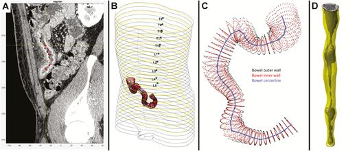 Illustration of bowel segmentation and reconstruction process. A, Radiologist places reference center points to identify distal small bowel. B, Centerline within small bowel is shown in 3D space in the context of patient abdominal silhouette. C, Centerline shown with automatically identified inner and outer bowel wall perimeters using superpixel voxel segmentation followed by k-means classification, allowing segmentation of lumen, bowel wall, and extra-intestinal space. D, Example of straightened tube-like reconstruction of segmented intestine with bowel wall and shaded lumen identified.