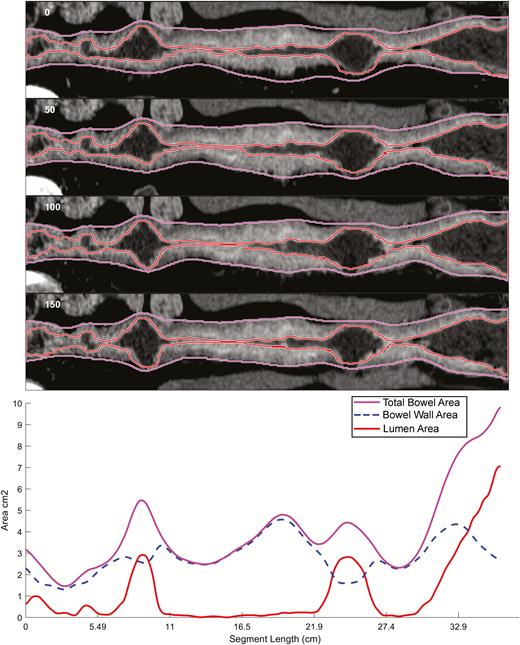 Example of small bowel segmentation and quantitative output. A representation of small bowel segmentation, with total bowel cross-sectional area, bowel wall area, and lumen area, expressed as centimeters squared. Projections of segmented bowel rotated about the lumen centerline at 0, 50, 100, and 150 degrees are shown; data from all 360-degree rotational projections are incorporated into bowel measurements. Data can also be exported into tabular format. The conversion from cross sectional area into an ideal equivalent diameter (for bowel dilation and lumen measurements) is the square root of cross-sectional area divided by π.