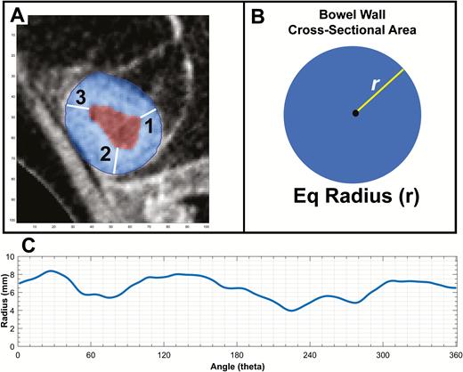 Comparing linear on-screen measurements and automated equivalent linear measures derived from cross-sectional areas. A, An example axial section of diseased small bowel with bowel wall masked in blue and lumen masked in red based on automated segmentation. B, The process of equivalent radius generation, where the total bowel wall area is reformed into a perfect circle and the (equivalent) radius is measured as the square root of Area/ π. In this case, the equivalent BWT radius is 7.3 mm compared with radiologist A measuring 8.1 mm and radiologist B measuring 7.1 mm. C, The variability of bowel wall thickness over 360 degrees of rotation about the estimated lumen center. Measures vary between a bowel wall thickness of 8.3 mm and 4.1 mm based on the location of measurement in the same cross-sectional segment.