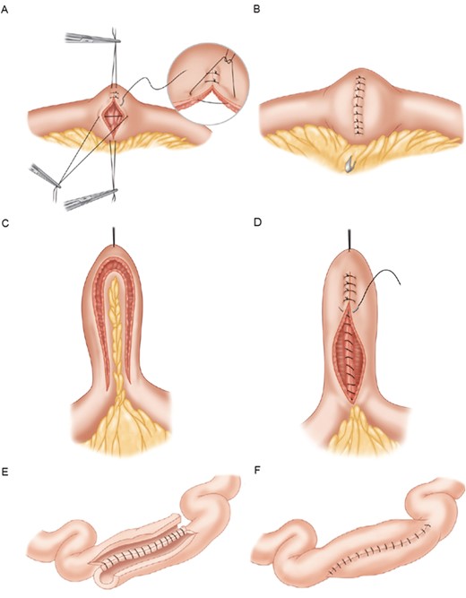 A, Heineke-Mickulicz strictureplasty. Longitudinal enterotomy followed by transverse apposition and suture closure. B, Completed Heineke-Mickulicz strictureplasty. C, Finney strictureplasty. Bowel arranged in U-shape with incision of the antimesenteric border. D, Creation of side-to-side anastomosis. E, Michelassi strictureplasty. Midpoint division of the bowel with longitudinal enterotomy. F, Adjacent loops of bowel joined in 2-layer fashion. Figure adapted with permission from Elsevier: Scott A. Strong, Chapter 23. Surgery for Crohn Disease. In: H.R. Bailey, et al. Colorectal Surgery, Elsevier: Saunders, 2013, pages 375-377.