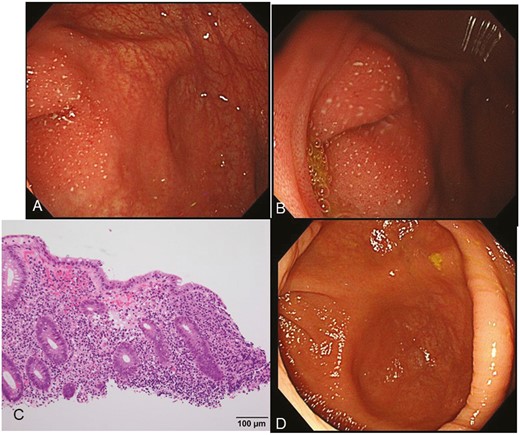 Endoscopic images of the cecum at the initial visit (A, B) and on the 43rd hospital day after infliximab and plant-based diet as first-line (IPF) therapy (D). Microscopic image (C) of appendiceal orifice inflammation (AOI). On the left side, slightly protrusive inflamed mucosa with white spots was observed in the appendix orifice. A vascular pattern is seen in the background (A). Inflammation is limited to the site of the appendiceal orifice (B). Lymphocyte and neutrophil infiltration, goblet cell depletion, and mild cryptitis are observed (C). After IPF treatment, the inflammation in the appendiceal orifice resolved (D).