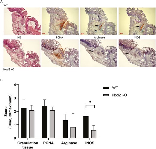 (5A), Representative picture of an anastomosis harvested on postoperative day 5 (10× magnification). The arrow indicates the zone of arginase I or iNOS expression in the WT mice (upper panel) and the Nod2 KO mice (lower panel). (5B) Results of the semi-quantitative analysis of the histology. Sections of the anastomosis were analyzed in a blinded manner by 6 different individuals and scored as following: absence = 0, slight = 1, moderate = 2, and massive = 3. Granulation tissue formation as measured by HE staining (P = 0.3) and cell proliferation as measured by PCNA staining (P = 0.069) showed no significant difference between both groups. The iNOS expression, however, was significantly reduced at the anastomosis (P < 0.05; Mann-Whitney U test). The results are expressed as median + IQR, n = 4 per group. HE indicates hematoxylin and eosin; IQR, interquartile ratio.