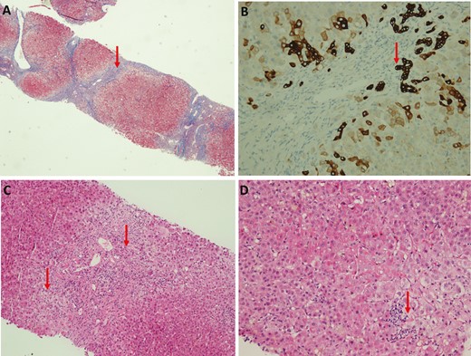 A, Low magnification showed bridging fibrosis. B, CK7 staining showed florid ductal proliferation. C, Medium magnification showed interface hepatitis and ductopenia in portal tract. D, High magnification showed lobular hepatitis.