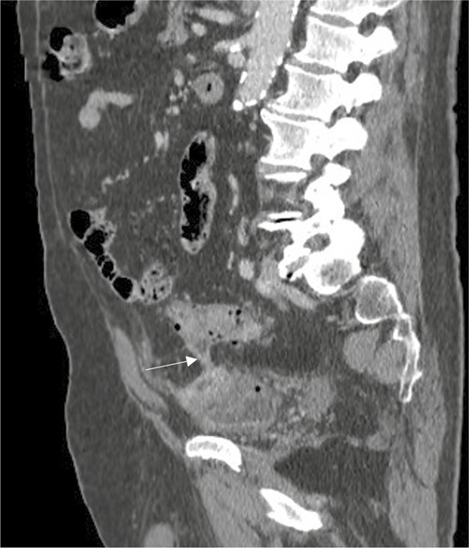 Portal venous sagittal computed tomography (CT) scan demonstrates a fistulous tract between the sigmoid colon and bladder wall (white arrow). There is a locule of intravesical air posteriorly, bladder wall thickening, and enhancement reflecting inflammation. Incidental, noninflamed sigmoid diverticular disease.