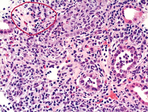 A high-power (100x magnification) haematoxylin and eosin (H&E) stain, derived from a biopsy of the interstitial compartment of the renal parenchyma from a patient with Crohn’s disease. There is an intense eosinophil-rich interstitial infiltrate (example encircled in red) comprising polymorphonuclear leucocytes and lymphocytes, in some places exhibiting “tubilitis” (infiltration and blockage of the renal tubular lumina by cells) (See online version for color figure).