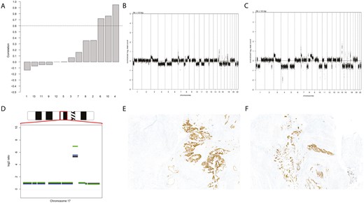 A, Correlation coefficients (y-axis) of colorectal and pouch neoplasia for individual patients (x-axis). Patients 6, 10, and 4 have coefficients above 0.6, indicating clonality. B and C, Clonally related copy number aberration profiles for patient 4 of colorectal neoplasia (B) and pouch neoplasia (C). The profiles are overall very similar, in line with correlation testing. The x-axis displays 100-kbp genomic bins sorted by chromosomal position. The boundaries between chromosomes are indicated by dotted lines. The y-axis displays the normalized log2 read counts. Positive values represent gains; negative values represent losses. D, DNA copy number profile of chromosome 17 of the colorectal cancer sample of patient 10. Zoom in on the cytobands q12, q21.1, and q21.2 of chromosome 17 (red square) for the DNA copy number profiles of patient 10 (colorectal cancer = black; pouch sample 1 = blue; pouch sample 2 = green). A large region including the human epidermal growth factor receptor 2 (HER2) gene is amplified. This amplification is detected in all 3 samples. E and F, Representative images of HER2 immunohistochemistry of the colorectal neoplasia (E) and pouch neoplasia (F) of patient 10. HER2 expression (brown staining) are clearly present in tumor cells, confirming the results from the copy number aberration analysis.