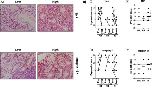 Immunohistochemistry for tumor necrosis factor (TNF) and integrin-β7 was performed on biopsies sampled before and after biologic treatment. Expression was scored on a scale of 0 to 3 in which 0 = none, 1 = low (<30%), 2 = medium (30%-60%), and 3 = high (>60%). A, Representative images of tissues with high and low expression. B, Summary of scores for tissues from patients classified as nonresponder (NR), partial responder (PR), and responder (R). i and ii indicate actual scores. iii and iv show reduction in score from pre- to posttreatment (pre score minus post score). Numbers indicate the number of patients represented where data points overlap.