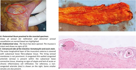 Macroscopic and histological view of a segment of ileum showing areas of serosal fat infiltration and abnormal serosal vasodilation.
