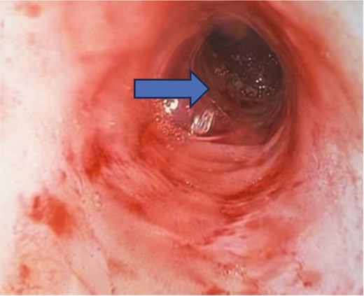 Showing an inadvertent ileal pouch-rectal anastomosis as there is a long segment of retained rectum on pouchoscopy. The ileal pouch begins at the mid-rectum (arrow) and not at the proximal anal canal.