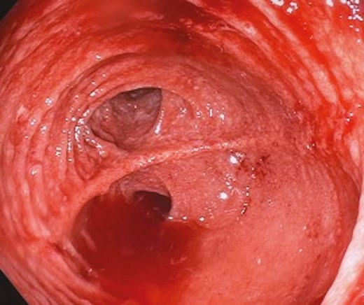 Pouchoscopy on a supine patient with an IPAA, demonstrating a vertically stacked owl’s eye with an almost horizontal staple line, indicative of a partial pouch twist.