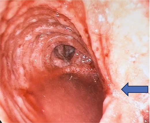 Pouchoscopy in a supine patient with an IPAA, showing a mid-pouch body stricture (arrow), pouchitis, signs of a twisted pouch with vertically stacked owl’s eye with corresponding staple lines on the left and right of the patient (not anterior and posterior).