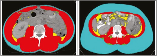 Axial CT images at the L3 level from 2 different patients with SliceOmatic (Tomovision) body composition analysis. Color overlay demonstrates subcutaneous fat area (blue), visceral fat area (yellow), intramuscular adipose tissue (green), and muscle attenuation (red) muscle (red), visceral fat (yellow), and IMAT (green).