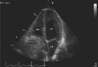 Echocardiography showing thrombus in the right coronary artery aneurysm (T-RCA aneurysm) compressing right atrium.