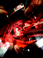 Intra-operative picture showing Foley's catheter (F) in the right coronary artery ostia and the right coronary artery aneurysmal sac (A).