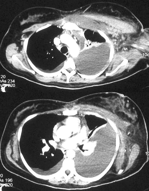 Chest CT-scan at 30 days.
