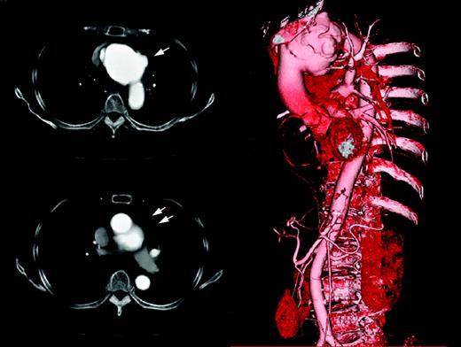 Enhanced CT-scan taken on admission. The infected aortic aneurysm was seen in the aortic arch with pseudoaneurysm (arrows).