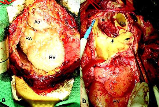 Intraoperative photographs. (a) Pericardium was heavily thickened and epicardium showed active infection with white fibrin-like deposition. (b) The aorta was opened at the aortic arch. The aortic wall was thickened and there was purulent discharge from the aortic wall. There were dirty mucus (*) and ulcerations (arrows) on the surface of the luminal wall of the aorta. Ao, ascending aorta; RA, right atrium; RV, right ventricle; Ds, distal arch.
