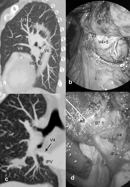 Patient 1: common venous trunk on the left side for a patient with planned VATS left lower lobectomy. Sagittal maximum intensity projections (MIP) clearly show the venous trunk continuing from the upper and lower lobe veins (a). Two branches (V6 and V8+V9–10) of drainage veins from the lower lobe are stapled together, with preservation of the venous braches of the left upper lobe (b). Patient 2: right V4 anomalous venous drainage for a patient with planned VATS right lower lobectomy. Coronal MIP shows V4 draining into the cephalic side of the inferior pulmonary vein (IPV) (c). In surgery, the right middle lobe vein was confirmed to drain into the inferior pulmonary vein, after dividing the anterior portion of the major fissure and taping the lower lobe vein (d).