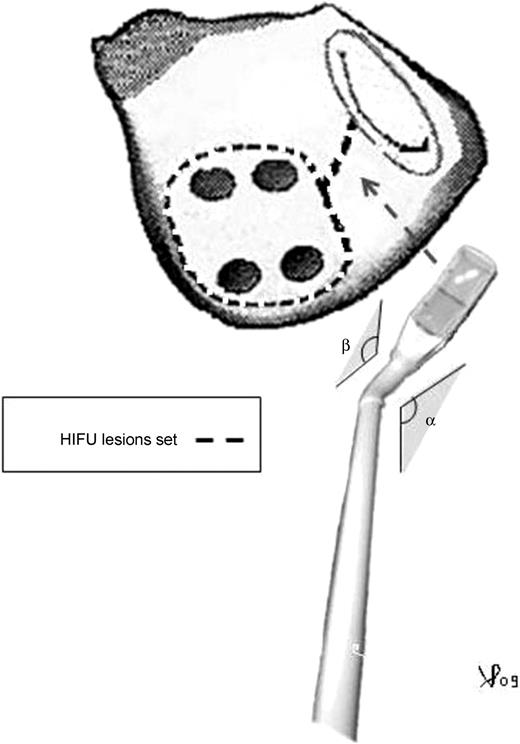 Illustration of the extracardiac left maze lesion pattern; α and β represent the angle of the ablation probe pre-formed before chest positioning. HIFU, high intensity focused ultrasound.