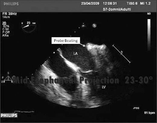 Positioning of the ablation probe on the mitral line verified by transesophageal echocardiography.