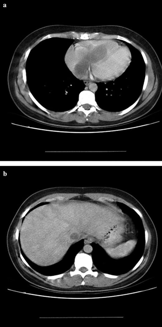 (a) CT-scan of a leiomyomatosis in the right atrium. (b) CT-scan of a leiomyomatosis in the inferior vena cava.