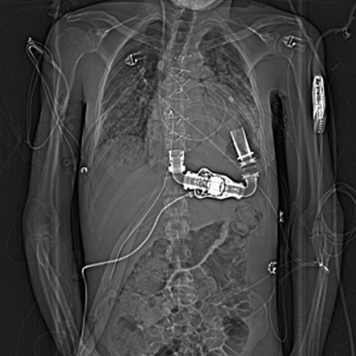 Chest X-ray imaging of position of CentriMag (Levitronix LLC, Waltham, MA, USA) RVAD cannulae on right side through the chest wall and inferior to the medial third of right costal margins just nearby the HeartMate II LVAD (Thoratec Corp, Pleasanton, CA, USA) driveline.