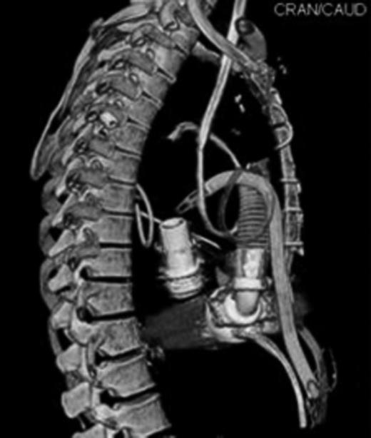 Position of mechanical support devices cannulae in 3-D computed tomography (CT) scan reconstruction.