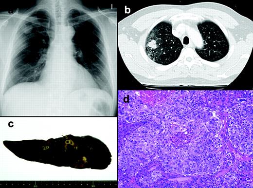 Radiological and pathological findings of the lung cancer. (a) Preoperative chest X-ray. (b) Preoperative chest CT. (c) Macroscopically, the lung cancer contained a hemorrhagic area. (d) Histology of the lung cancer showing squamous differentiation.