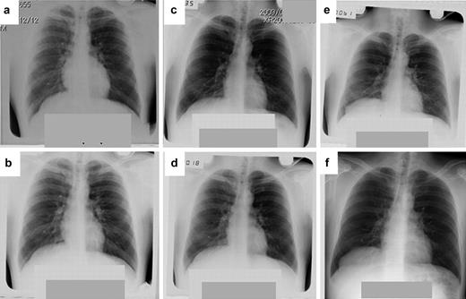 The time course of the 20-year natural history of chest roentgenogram in the giant pericardial cyst. (a) 1990, (b) 1995, (c) 2005, (d) 2006, (e) 2008 and (f) 2009.