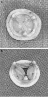 (a) A 21 mm explanted degenerated bioprosthesis, and (b) matching sized bioprosthesis with simulated degeneration.