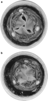 (a) 23 mm TAVI within a 21 mm degenerated bioprosthesis. (b) 23 mm TAVI within a 19 mm degenerated bioprosthesis.