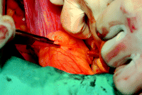 Lipoma attached to the posterior pericardium beneath left pulmonary artery – intraoperative view.