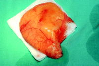 Tumor measured 6×6×3 cm.