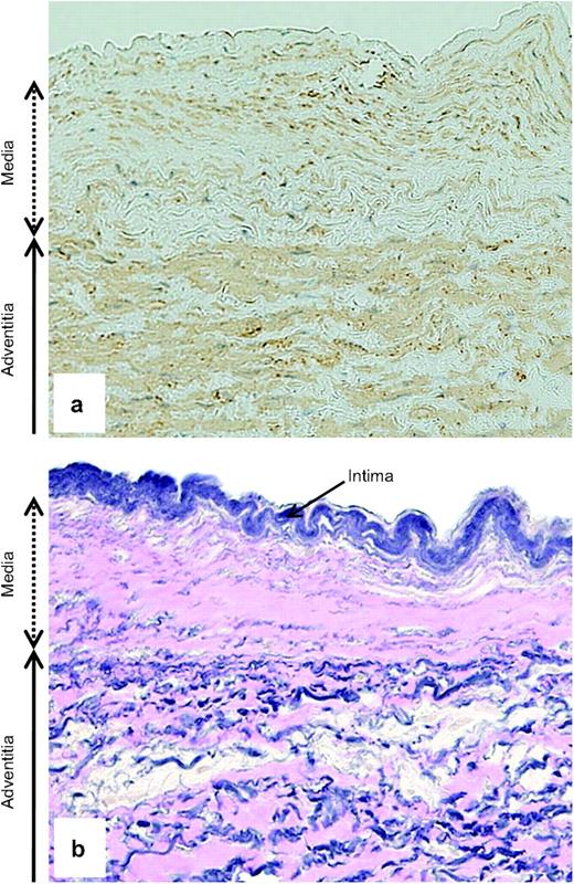 Stains with α-SMA (a) and Elastica–van Gieson (b) of the main pulmonary arterial wall (original magnification, ×200). (a) The medial layer is decreased in thickness, with its muscular component (light brown) being remarkably attenuated. (b) Of particular note is the disarray and fragmentation of the medial elastin (dark blue) as being replaced with collagenous tissue (pink).