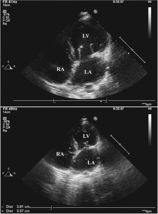 Echocardiogram at five-year follow-up. Cross-sectional view along the four-chamber plane. On the top panel, a diastolic frame showing normal cusp opening of the mitral valve with no annular enlargement. On the bottom panel, a systolic frame of mitral anatomy, with good coaptation depth and height. Both the left ventricle and left atrium show normal dimensions (see measurements of left atrium on the bottom panel). LA, left atrium; LV, left ventricle; RA, right atrium.