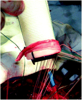 Passage of valve sutures through the pericardial strip encircling the valve sewing ring.