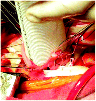 Fixing of valved conduit to left ventricular outflow tract with pericardial strip.