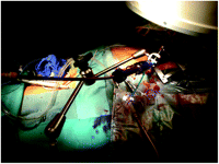 Intraoperative view of the introduction sheath fixed to the third hand.