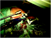 Intraoperative close view of the introduction sheath fixed to the third hand.