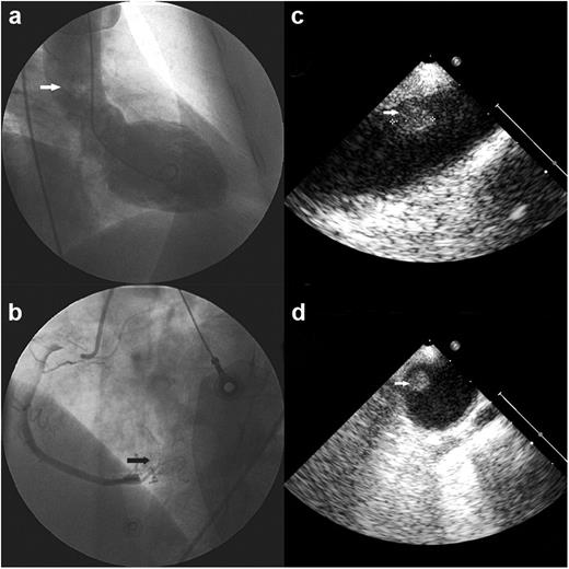 Selective angiography of the right coronary artery in a left anterior oblique angiographic view (b) demonstrates after contrast injection the presence of a myocardial blush (arrow), suggesting the transient occlusion and spontaneous reperfusion of the coronary artery. Left ventriculography in a right anterior oblique angiographic view (a) shows a moderate left ventricular systolic dysfunction with inferior hypokinesia and moderate mitral regurgitation. Visualization of the ascending thoracic aorta during ventriculography reveals an unexpectedly large filling defect (arrow) located in the proximal ascending portion of the thoracic aorta, without evidence of aortic dilatation or valvular regurgitation. Intraoperative transesophageal echocardiography in midesophageal ascending thoracic aorta long- (c) and short-axis (d) views demonstrates a circular, homogenous and echogenic mass (arrows) of ∼1 cm in diameter attached to the wall of the ascending aorta at the level of the distal aortic arch and proximal descending thoracic aorta junction.