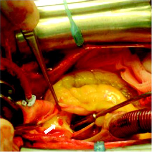 After an aortotomy under cardiopulmonary bypass, intraoperative inspection of the thoracic ascending aorta reveals a gelatinous tissue covering the aortic wall and the presence of a small peduncle located on the posterior wall of the ascending aorta (arrow).
