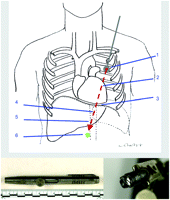 Upper panel: Trajectory of the bullet. The bullet perforated the left anterior chest and entered the left hemithorax transmediastinal, disrupting the left internal mammarian artery (1). It then penetrated the anterior wall of the right ventricle causing a pericardial tamponade (2). After leaving the heart dorsal through the right ventricle it emigrated via the diaphragm (3) into the liver, the spleen and the pancreas (4). Finally, it punched through the abdominal aorta 3 cm proximally to the coeliac trunk (5) and ended paravertebrally (6). Lower panel: shooting pen (on the left); projectile calibre .22 lr (on the right).