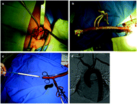(a) An 8-mm Dacron tube anastomosed to the right axillary artery and brought through another small stab incision; (b) a long tube with a 7-French sheath inserted and snared allows the introduction of wires, catheters and the device without bleeding; (c) a Gore-Tex (TAG) thoracic stent graft inserted through a rigid guide wire and the Dacron tube; (d) final aortography of two aortic extender cuffs deployed in the ascending aorta through the right axillary artery to treat a pseudoaneurysm.