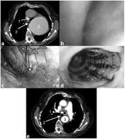 (a) Preoperative chest CT-scan. Left main bronchus (1) is displaced and compressed by massive aortic aneurysm of the thoracic aorta (3). Right main bronchus (2). (b) Bronchoscopy showing collapsed left main bronchus. (c) Nitinol stent implantation into the left main bronchus with residual collapse due to compression by the aneurysm. (d) Complete competent left main bronchus after early second step operation. (e) CT-scan at one-year follow-up with stented left main bronchus (1) and replacement of the aorta with a dacron prostheses (3). Right main bronchus (2).