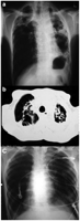 CXR (a) and CT-scan (b) showing multiple cavities destroying both lungs, more evident on the left lung, (c) showing CXR after excision of the tumor.