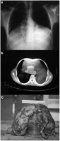 CXR (a) and CT-scan (b) showing the huge fatty tumor surrounding a normal sized heart. The thymoma was compressing the heart and filling both lower pleural cavities. (c) The tumor after excision.